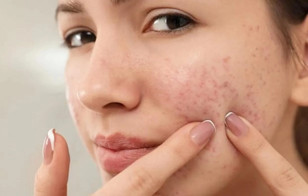 화농성 여드름 자주 묻는 질문(FAQ)