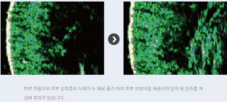 리쥬란-힐러-후기