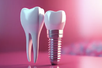 임플란트 모형 사진