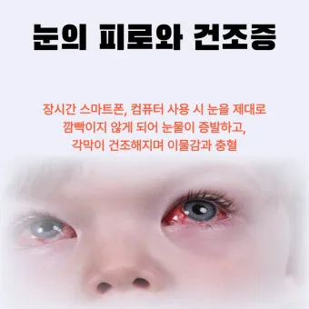 눈물이 자주 나는 이유에 대한 안과정보_26