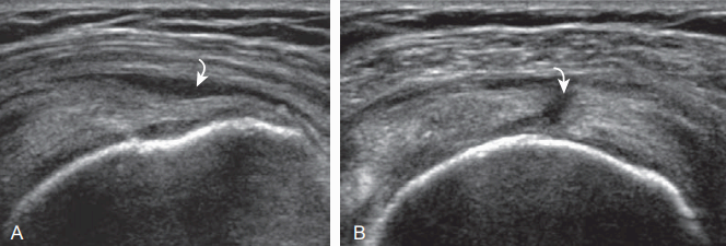 supraspinatus : full- thickness tear
