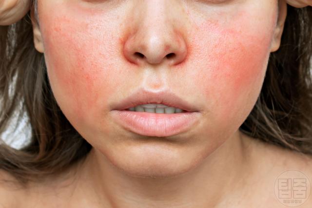 피부장벽 무너짐 증상 얼굴 붉어짐