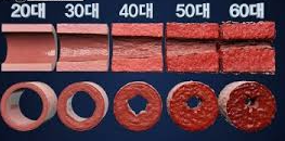 혈관 노화의 주요 원인