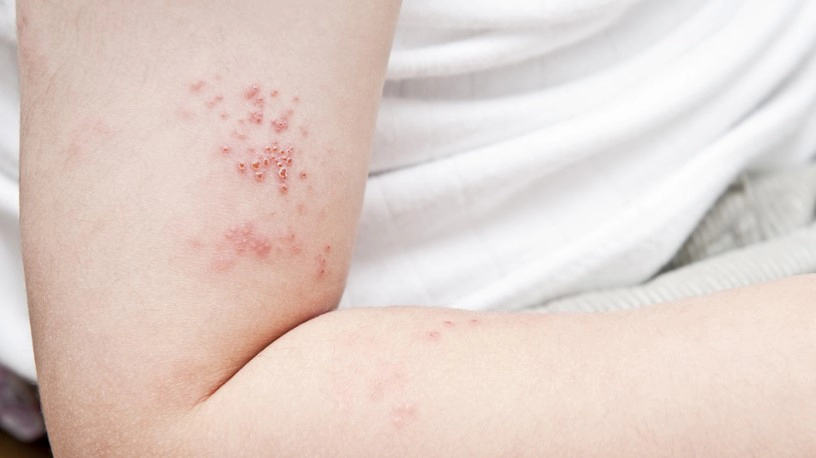 대상포진 전염성 허벅지 허리 팔 대상포진 증상 정리