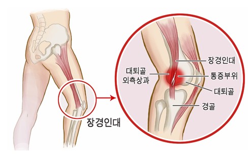 대퇴골 외측상과