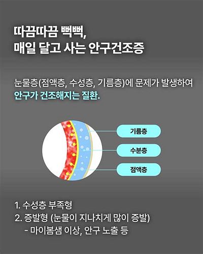 난시 라식