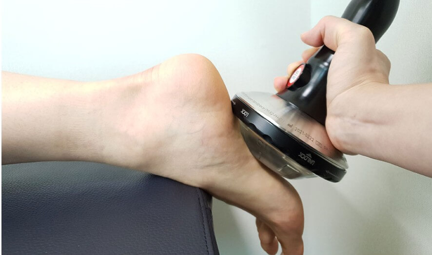 체외충격파 치료 중