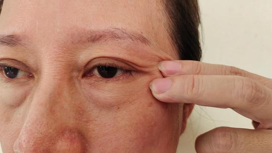 눈 처짐 개선을 위한 주요 시술과 방법