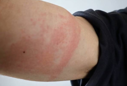 콜린성 두드러기