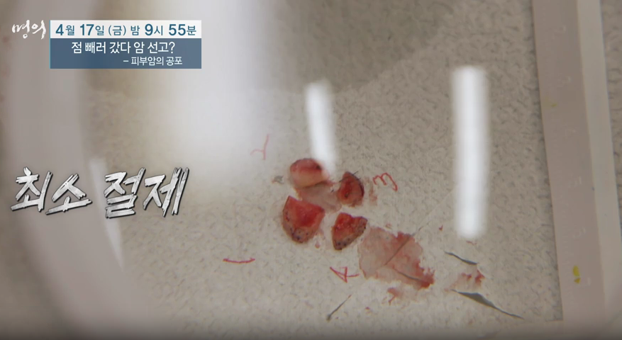 명의 피부암 점 구별법