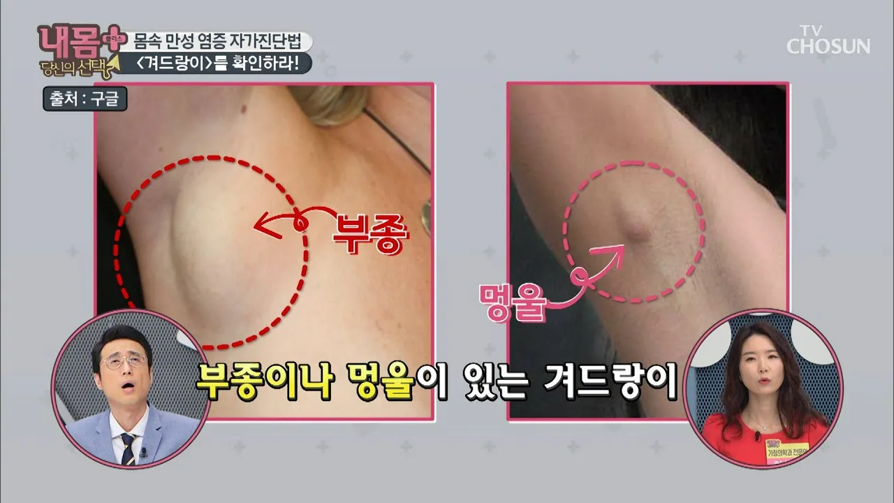 겨드랑이 통증