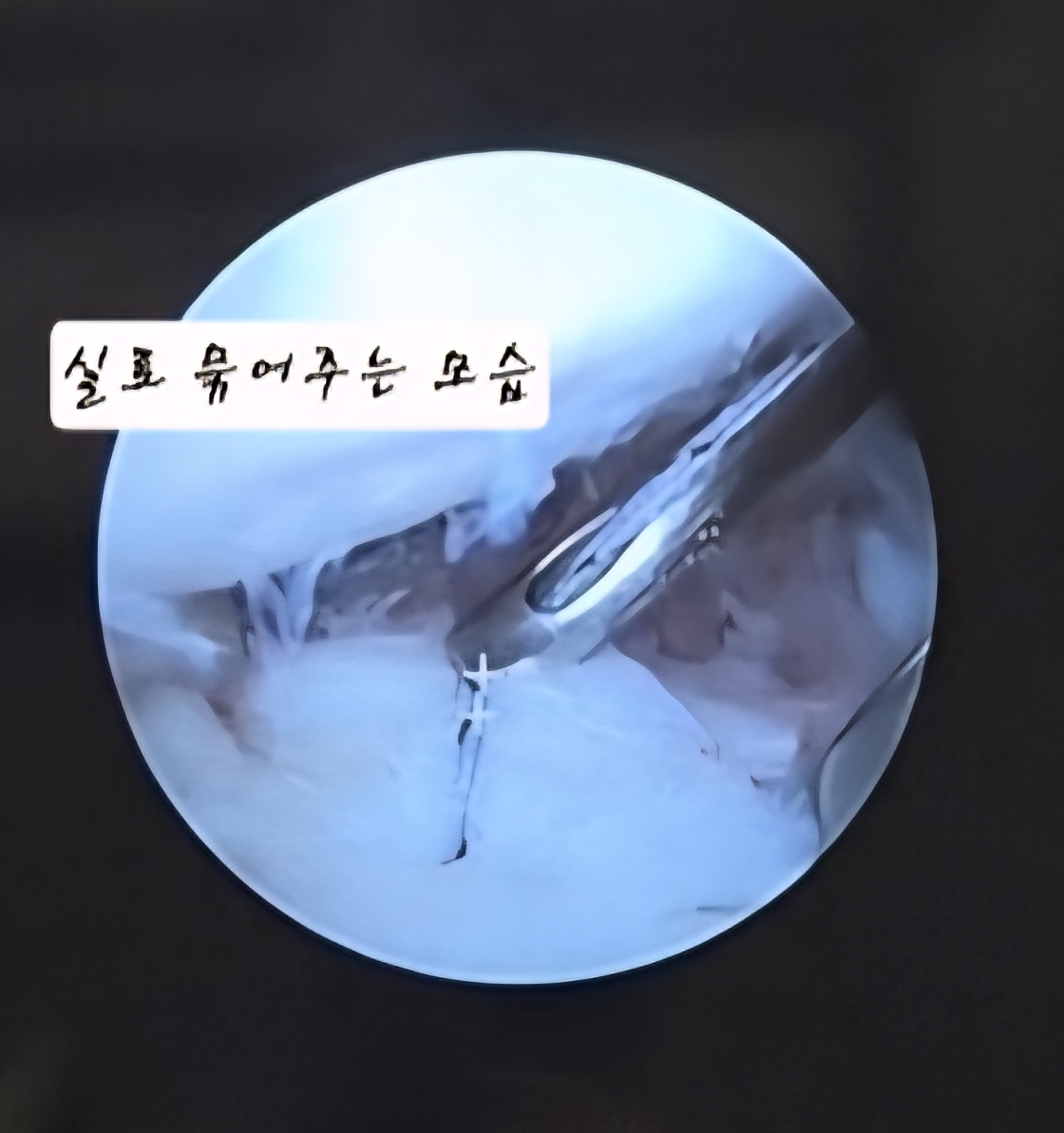 어깨 와순파열 봉합수술 후 mri사진 물리치료 기록