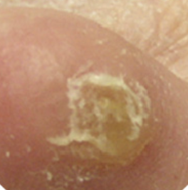 사마귀 제거방법 2