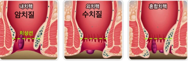 암치질? 수치질? 내치핵과 외치핵, 혼합치핵을 설명하는 이미지