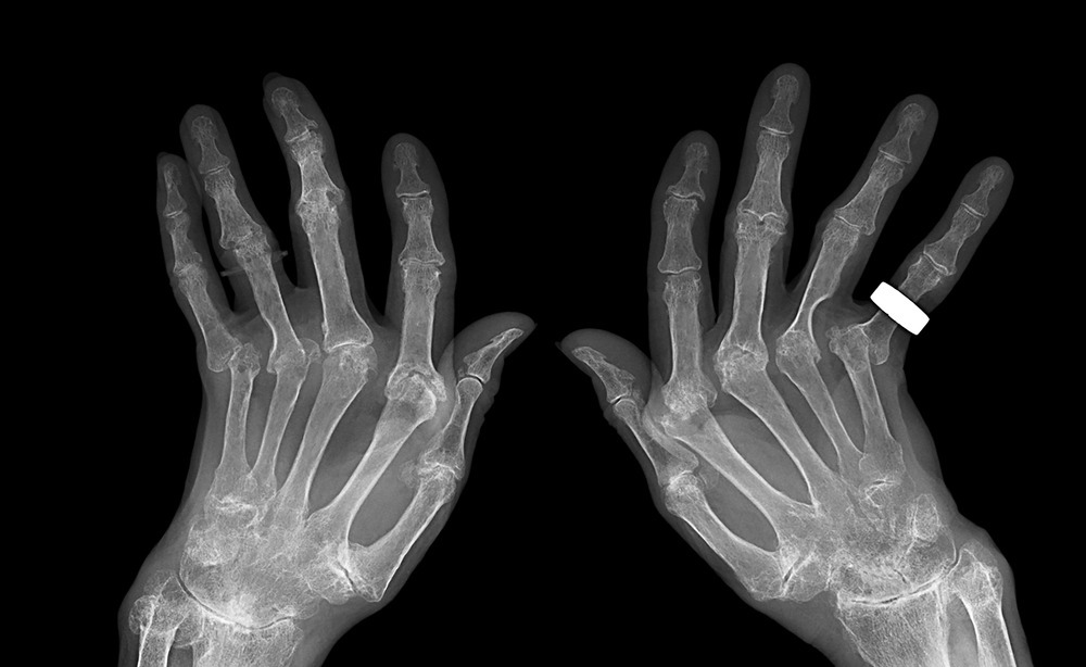 손가락-마디-통증-치료방법