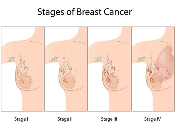 여성질환: 유방암- 잔단계와 진행방법, 관리단계, 마음가짐.