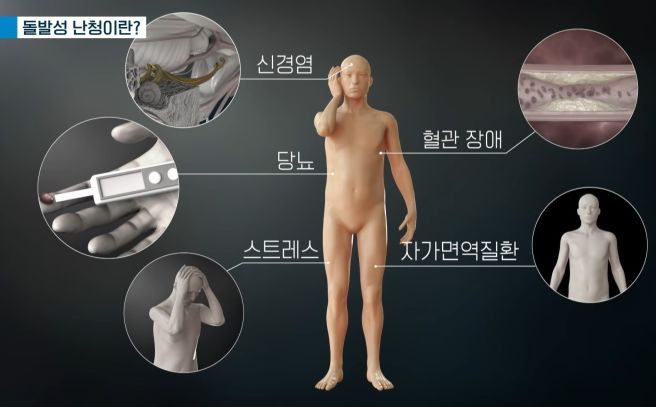 임기정 교수 저음역 난청과 메니에르병은 어떻게 다를까