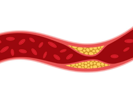 고지혈증 증상, 고지혈증에 좋은 음식, 고지혈증 수치 총정리 (2024ver)