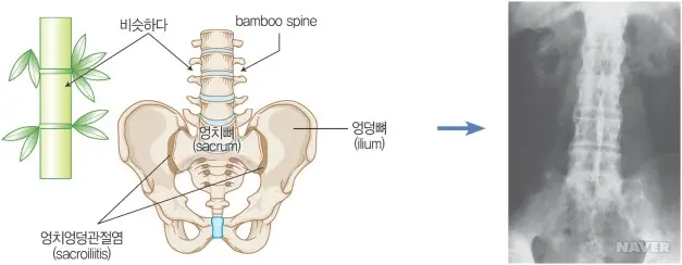 척수 관절염