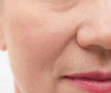 팔자주름 없애기 위한 방법