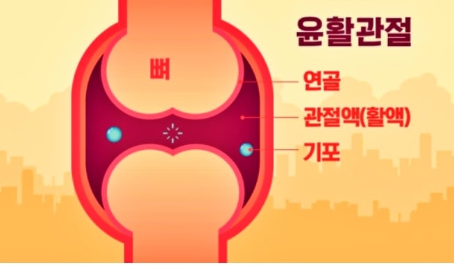 무릎-굽혔다-펼 때-나는-소리-관절내-기포
