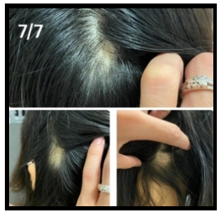 7월7일-탈모