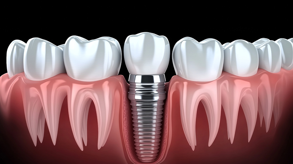 임플란트 시술과정