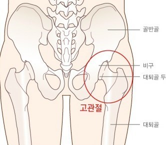 고관절통증과 고관절 소음증후군 메인이미지