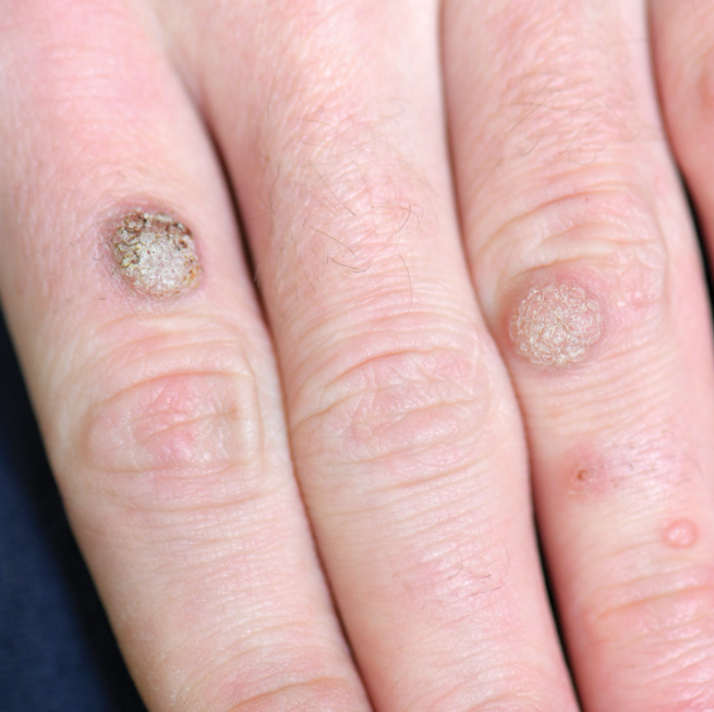 티눈과 사마귀의 차이점 및 치료법