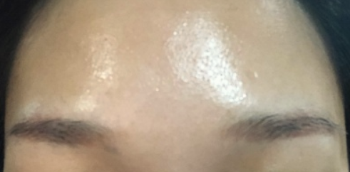 이마 미간 보톡스 후기7