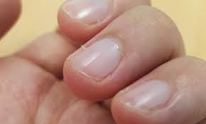 손톱이 잘 부러지는 이유