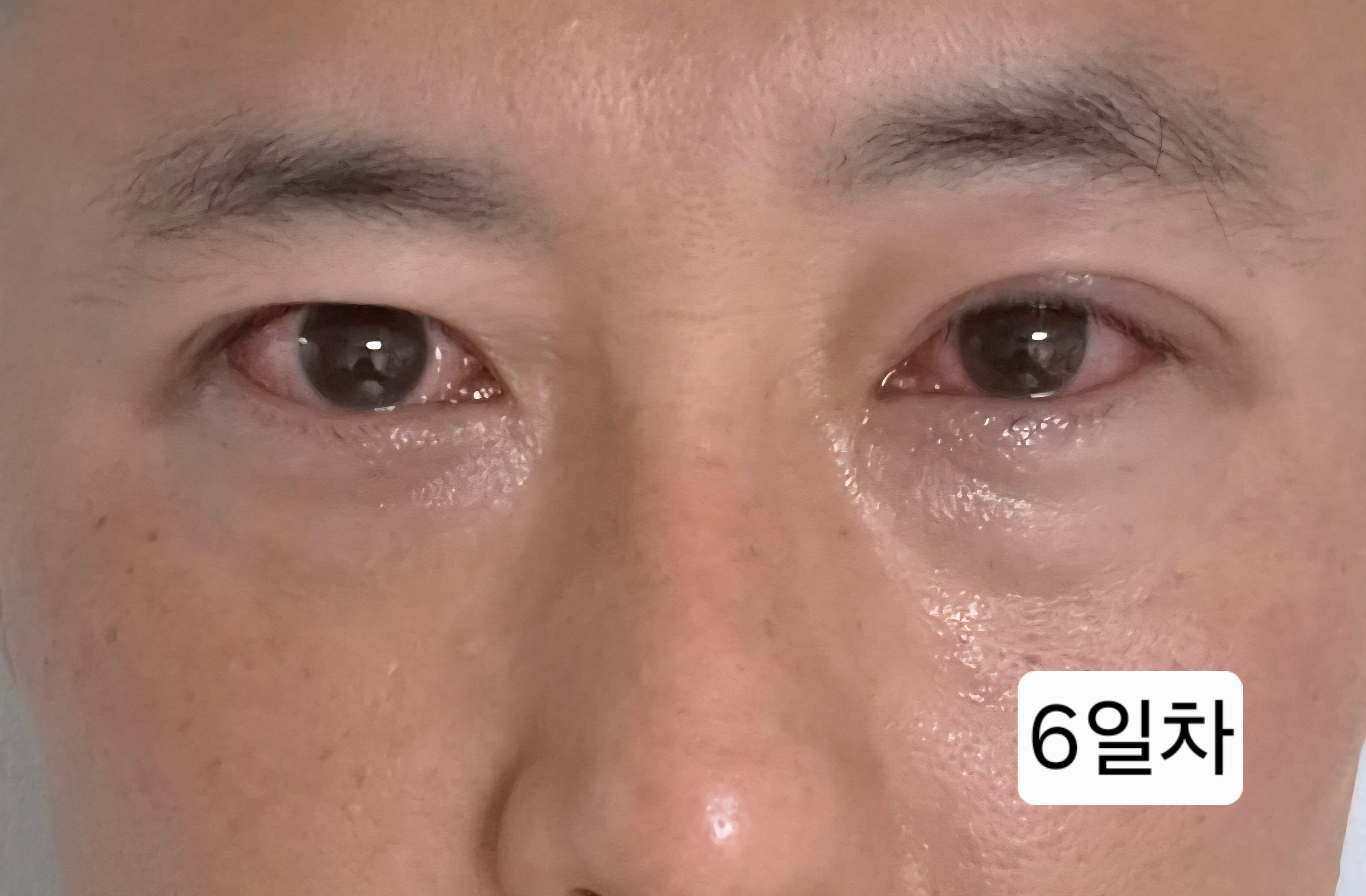 유행성각결막염 눈병 초기증상부터 12일차 치료 기록(진행 중)