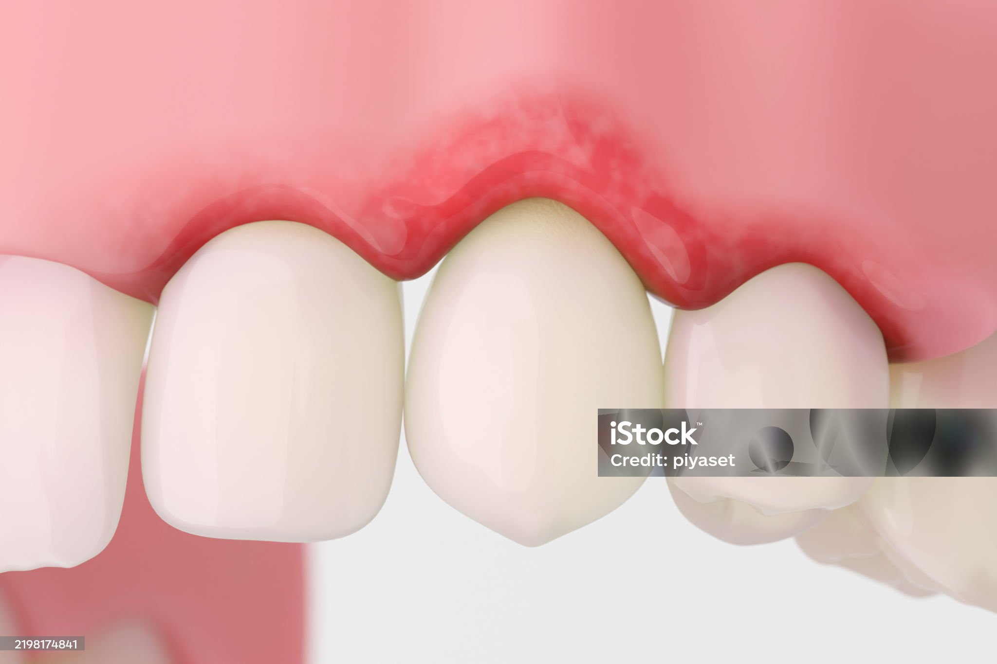 치은염-관련-사진