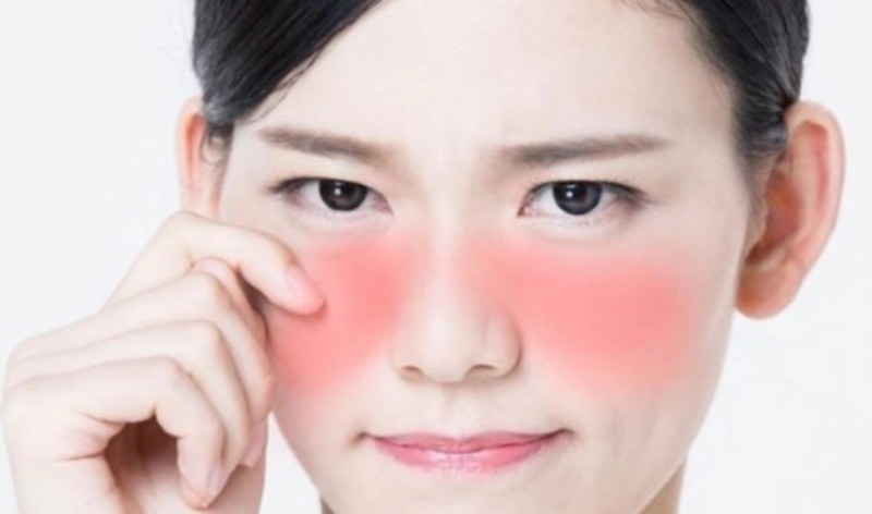 루푸스 증상 진단 검사 치료