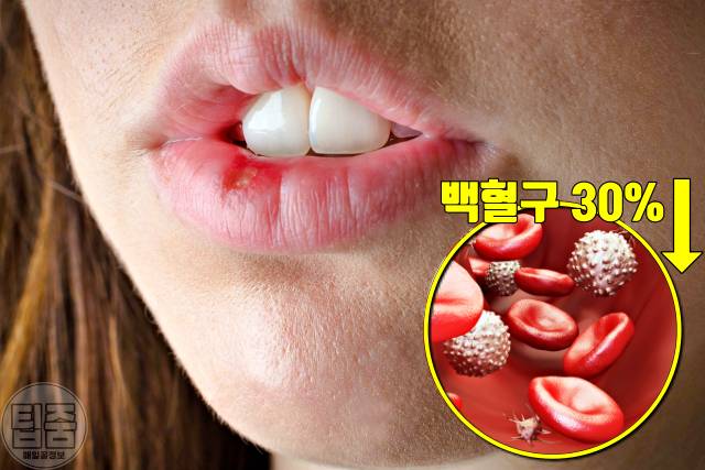 스트레스 받으면 이빨 흔들리는 이유,스트레스 잇몸 부음 이시림 출혈