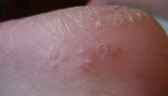 수포형 발무좀 (Vesicular type) 