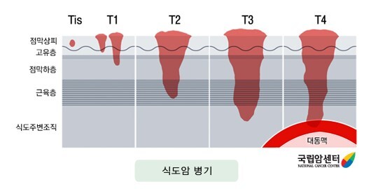 식도암의-단계별-진행모습