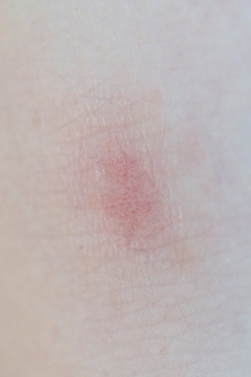 몸이 이유 없이 가려울 때 원인·증상·해결방법