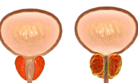 전립선 비대증 치료약