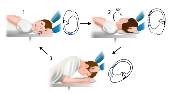 이석증 재발 막는 법