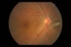 비문증 치료방법