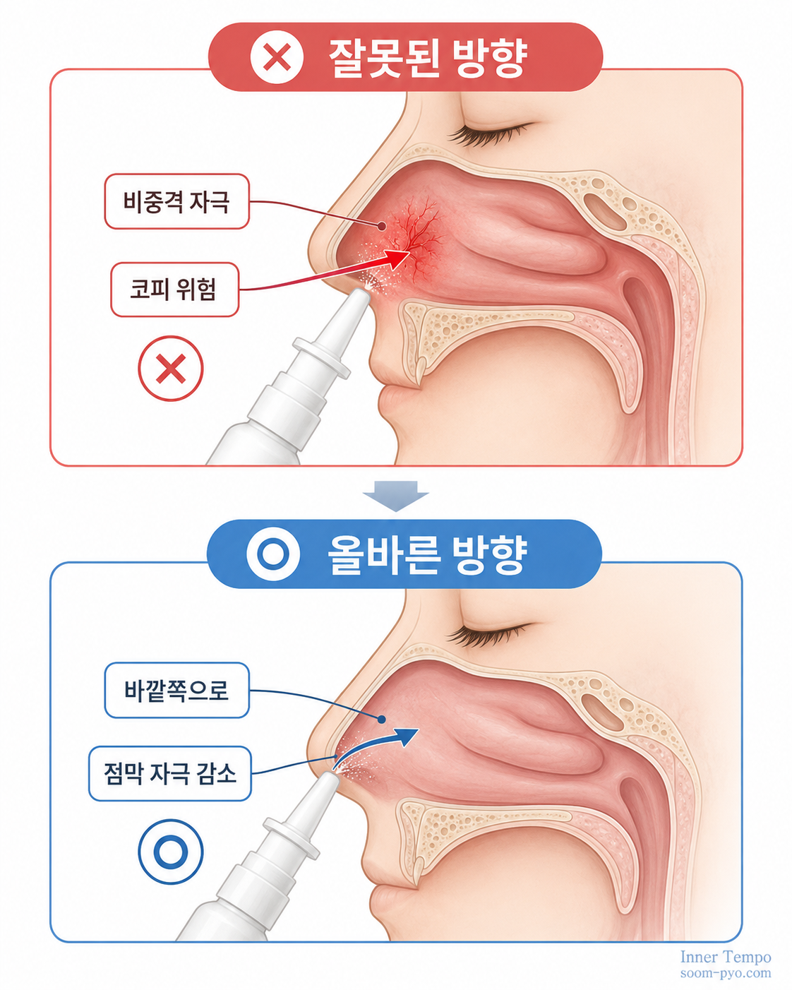 비염 스프레이 올바른 사용법