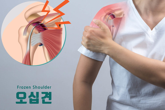 오십견 증상