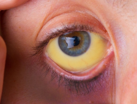 황달증상이 발생한 눈 사진입니다.