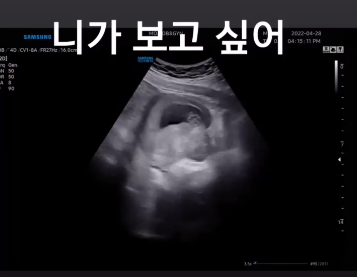 이재은 임신초음파