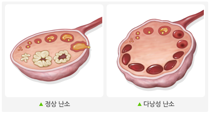 다낭성난소증후군 예시사진