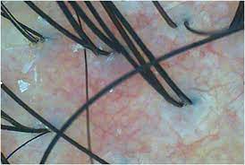 지성 두피 건성 두피 민감성 두피 탈모증상