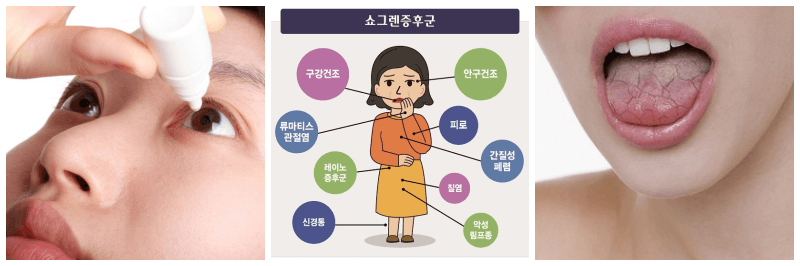 안약 넣는 모습, 쇼그렌 증후군, 혀 갈라진 사진