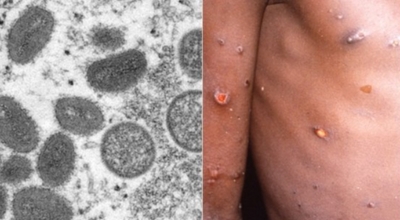 원숭이두창 이미지