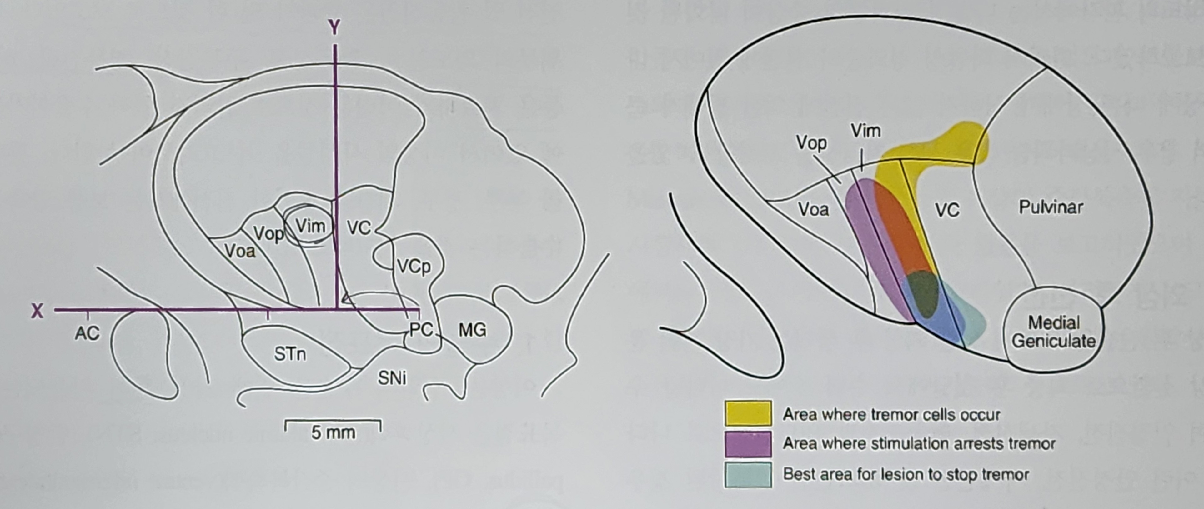 진전(Tremor)의 수술적 치료